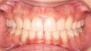 難しいケース1.叢生症例の治療後